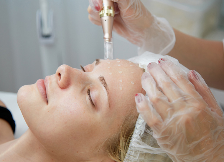 میکرونیدلینگ صورت کلینیک مهرافروز mehrafrouz