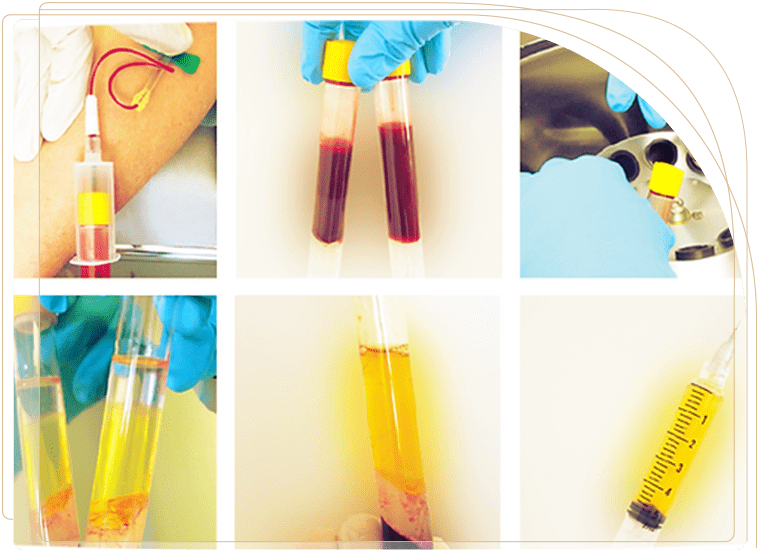 پی ار پی صورت