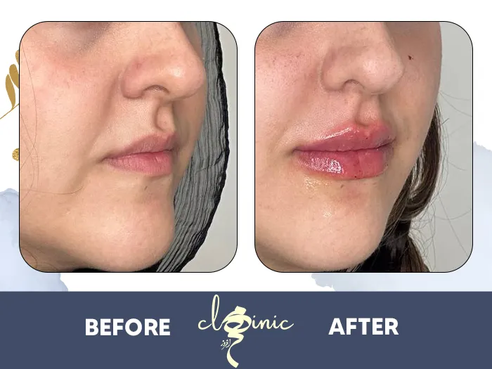 ژل لب یا تکنیک اگولیپس