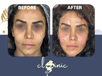 بیفور افتر اندولیفت