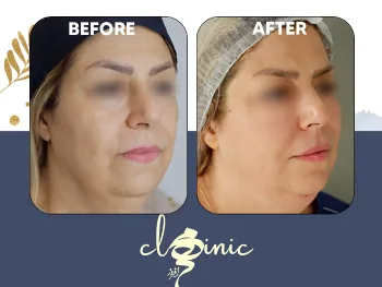 عکس قبل و بعد اندولیفت