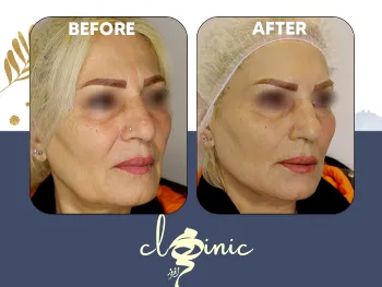 قبل و بعد اندولیفت