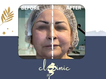 نمونه کار اندولیفت