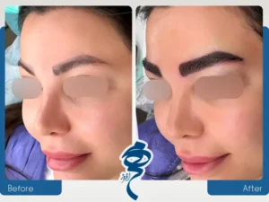 قیمت کاشت ابرو