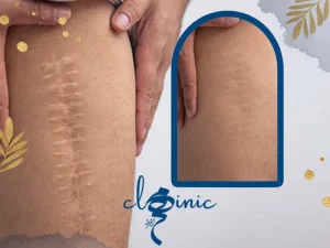 از بین بردن جای بخیه
