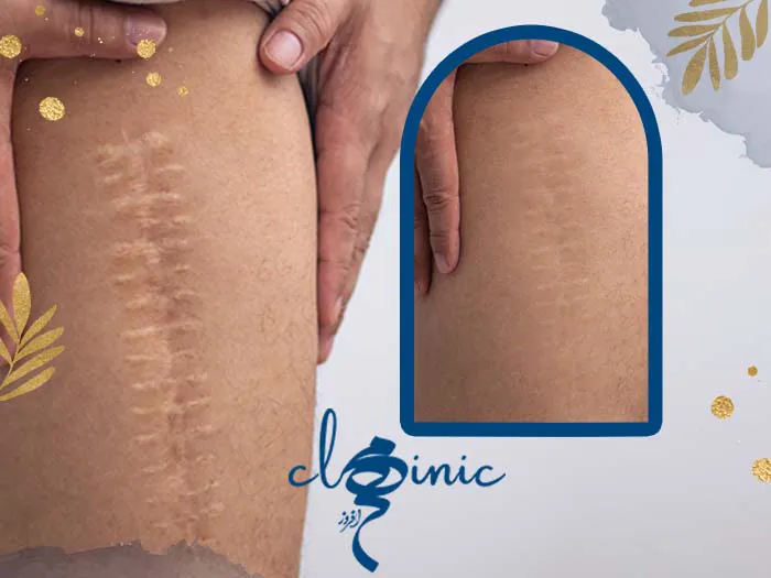 از بین بردن جای بخیه