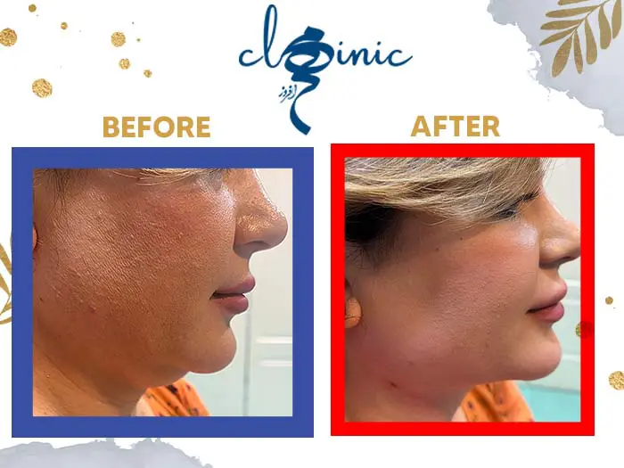 جراحی ساکشن غبغب