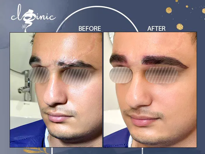 کاشت ابرو آقایان