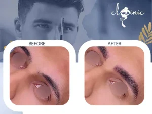 کاشت ابرو مردانه