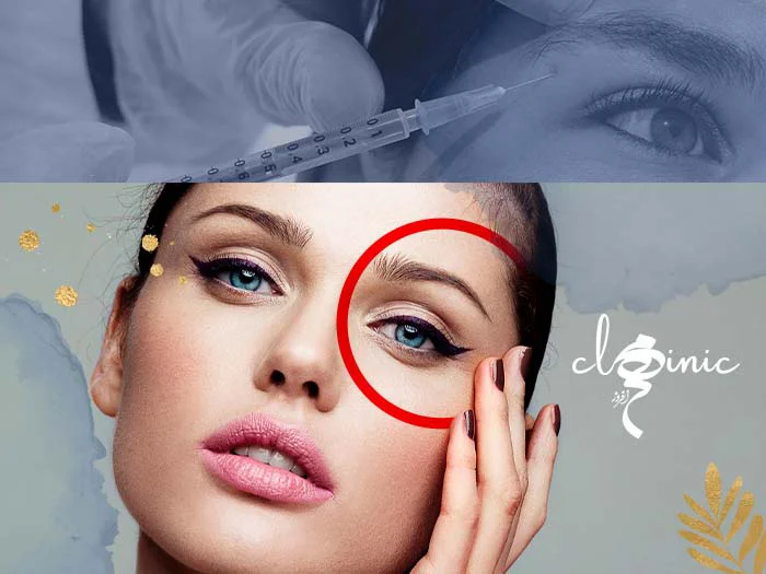 بوتاکس چشم گربه ای