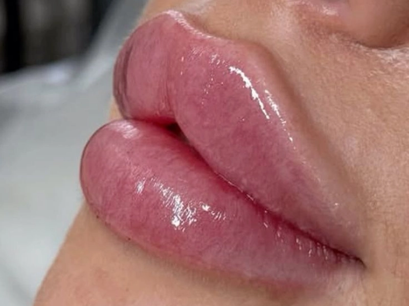 تزریق ژل لب روسی در تهران