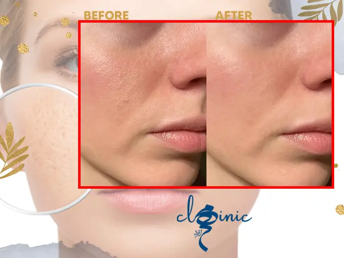 اصلاح منافذ باز پوست