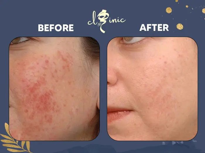 درمان جوش و آکنه صورت