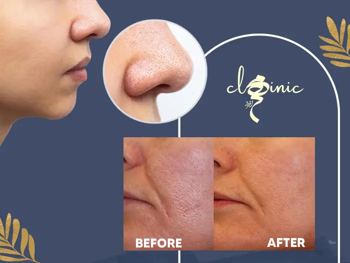 درمان منافذ باز پوست