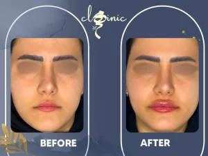 تزریق ژل لب مدل گرد
