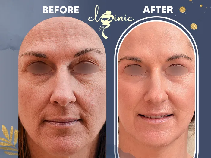 نتیجه کلاژن سازی پوست