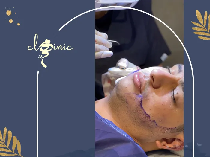 نمونه کار کاشت ریش