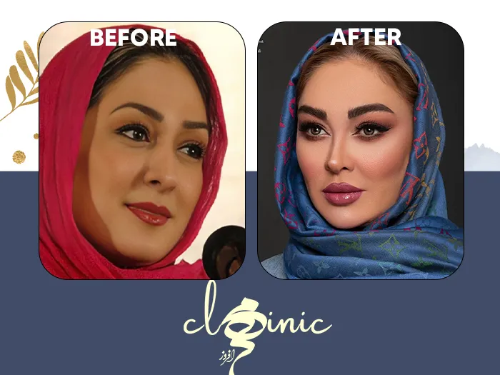 کاشت ابرو الهام حمیدی