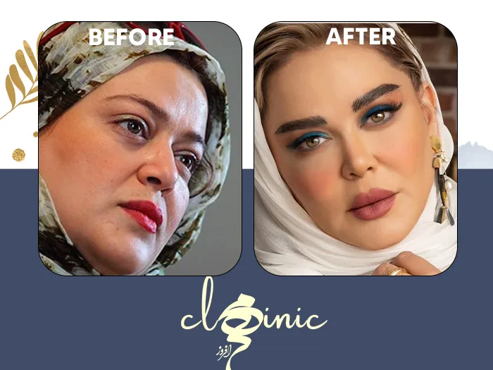 کاشت ابرو بهاره رهنما