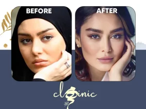 کاشت ابرو سحر قریشی