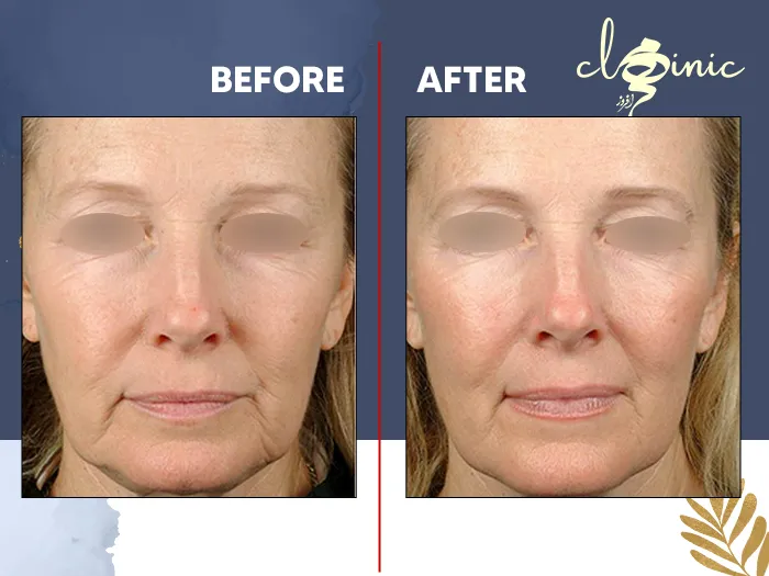 کلاژن سازی پوست