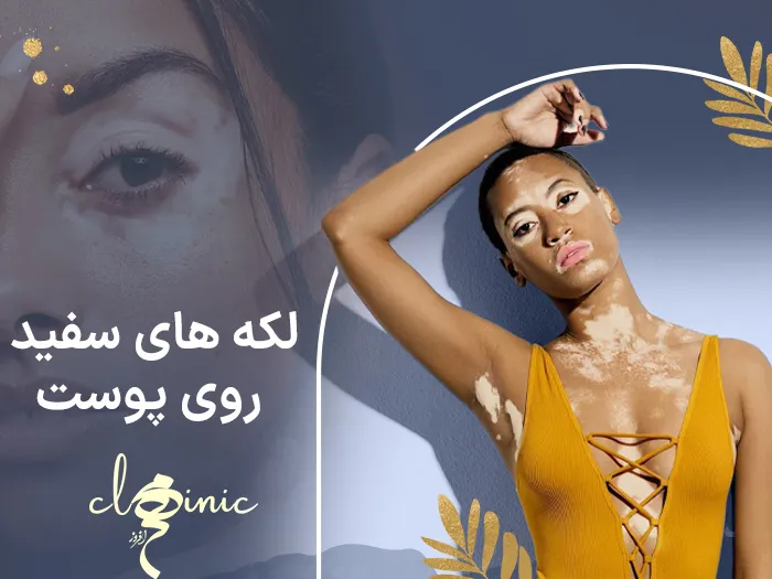 لکه های سفید روی پوست