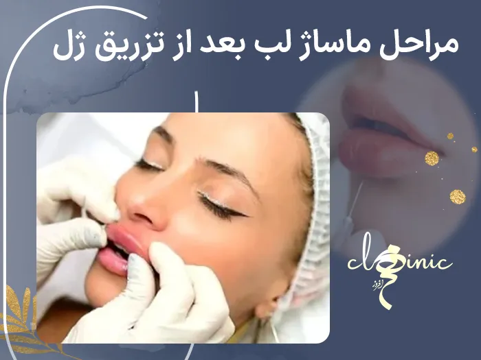 ماساژ لب بعد از تزریق ژل