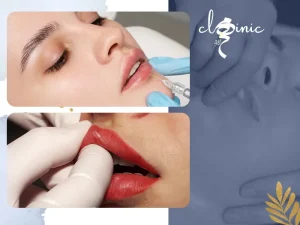 نحوه ماساژ بعد تزریق ژل لب