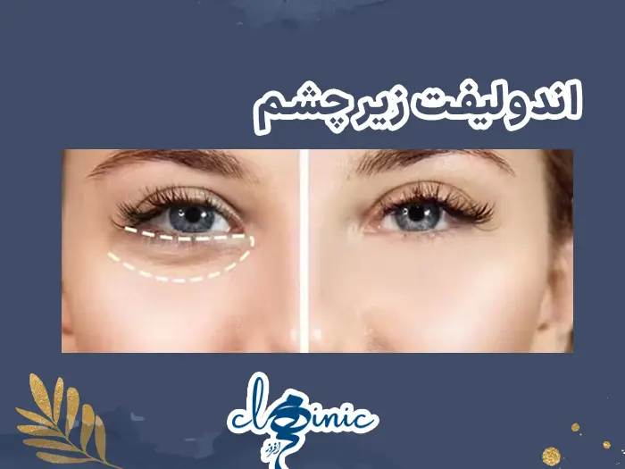 اندولیفت زیر چشم
