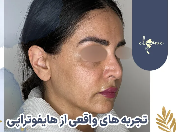 تجربه هایفو تراپی