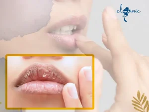 خشکی لب بعد از تزریق ژل