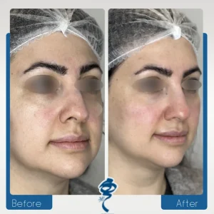 فیلر گونه و فرم دهی بینی