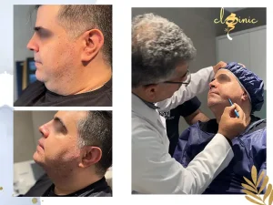 نتیجه اندولیفت غبغب