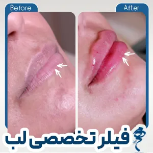 نمونه کار تزریقات زیبایی