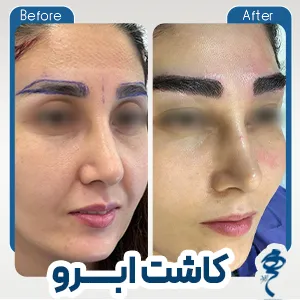 نمونه کار کاشت