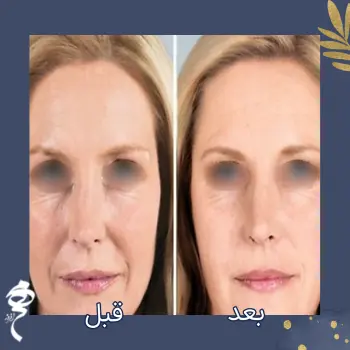 بیفور افتر پروفایلو