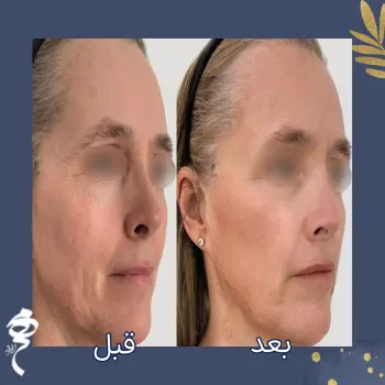 تزریق پروفایلو