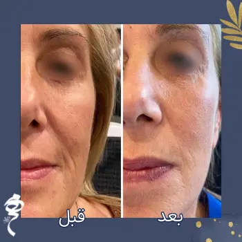 عکس قبل و بعد پروفایلو