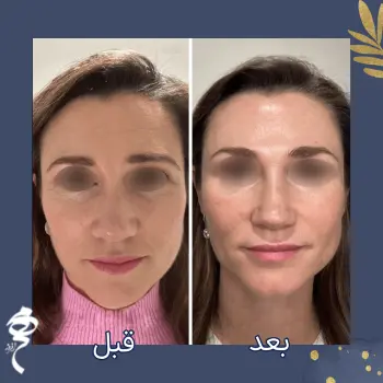 قبل و بعد تزریق پروفایلو
