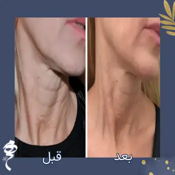 نمونه پروفایلو گردن