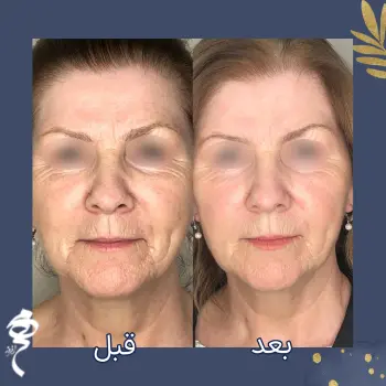 نمونه کار تزریق پروفایلو