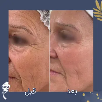 پروفایلو در سن پیری