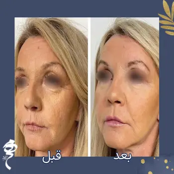 پروفایلو قبل و بعد