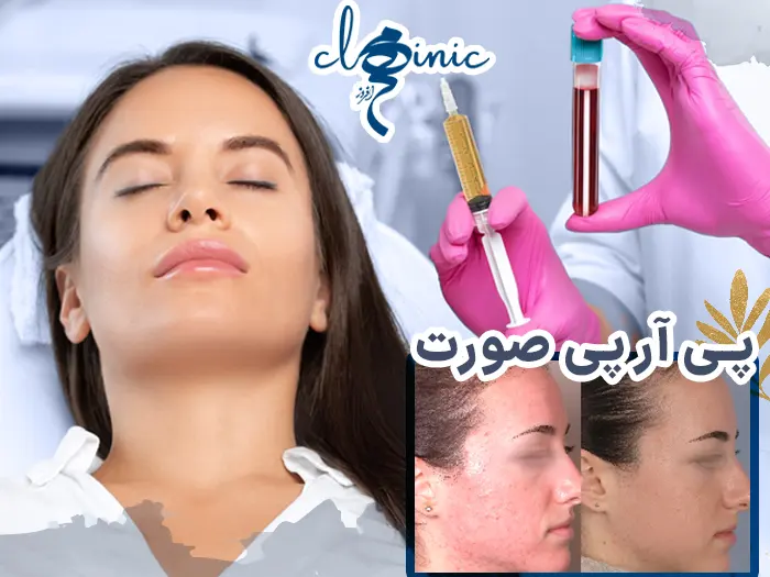 پی آر پی صورت