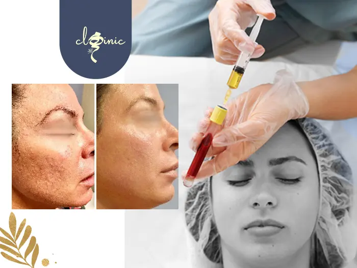 پی ار پی صورت