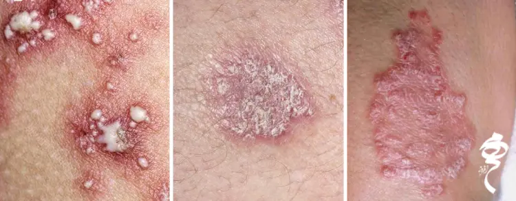 عکس انواع پسوریازیس + علت + درمان