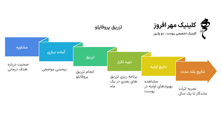 روند تزریق پروفایلو
