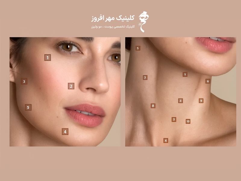 نقاط تزریق پروفایلو صورت