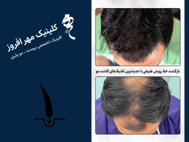 نمونه کاشت موی طبیعی