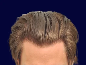 خط رویش طبیعی در کاشت مو چگونه است؟